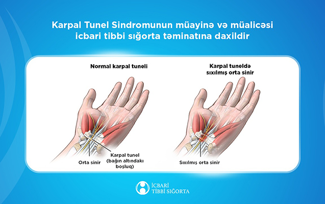 Karpal Tunel Sindromunun müalicəsi də icbari tibbi sığorta təminatına daxildir