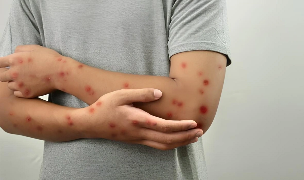 Meymunçiçəyi virusu dəyişir: Alimlər yeni mutasiya dalğasını aşkarladılar